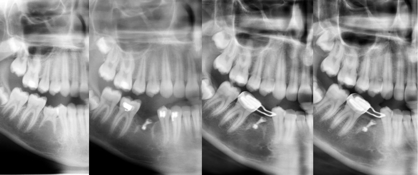 Figure 6 : cas 2, suivi radiographique de la croissance osseuse sur 3 ans