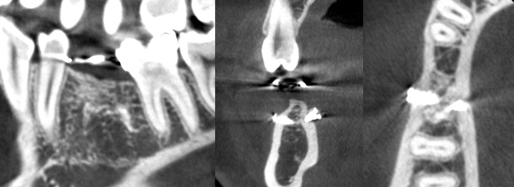 Figure 7 : cas 2, coupes CBCT à 3 ans