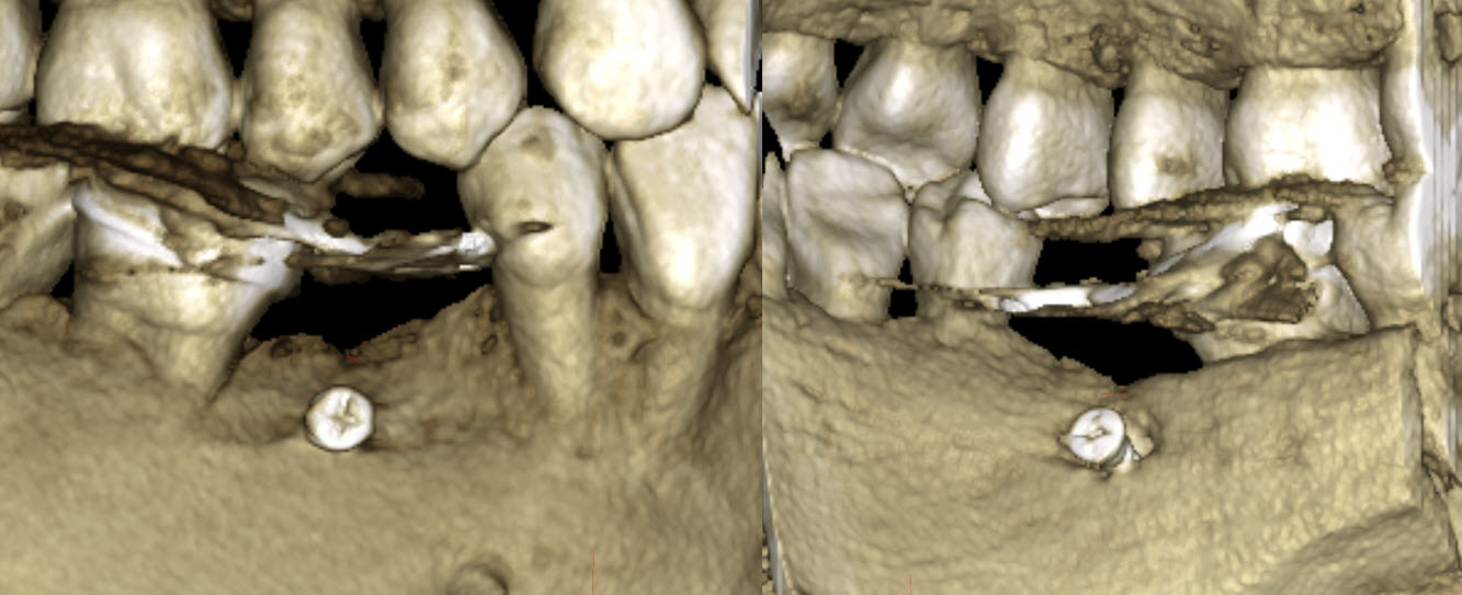 Figure 8 : cas 2, rendu surfacique au CBCT à 3 ans