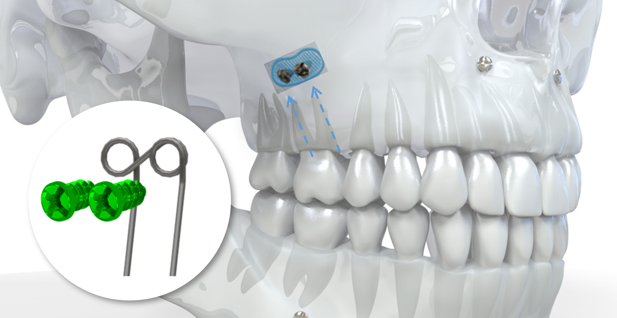 Implantation ingression molaire supérieure unilatérale ou bilatérale 