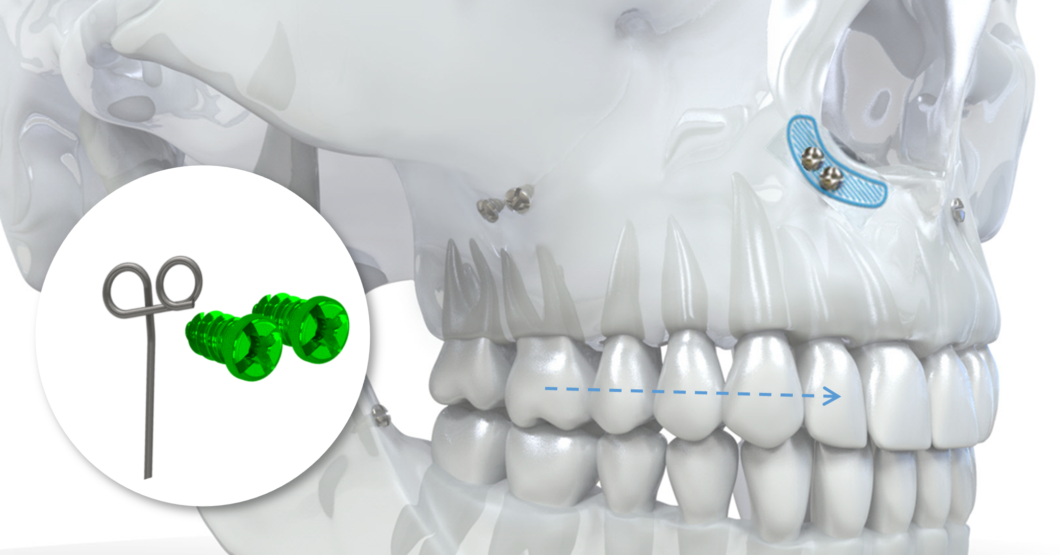 Implantation mésialisation latérale supérieure