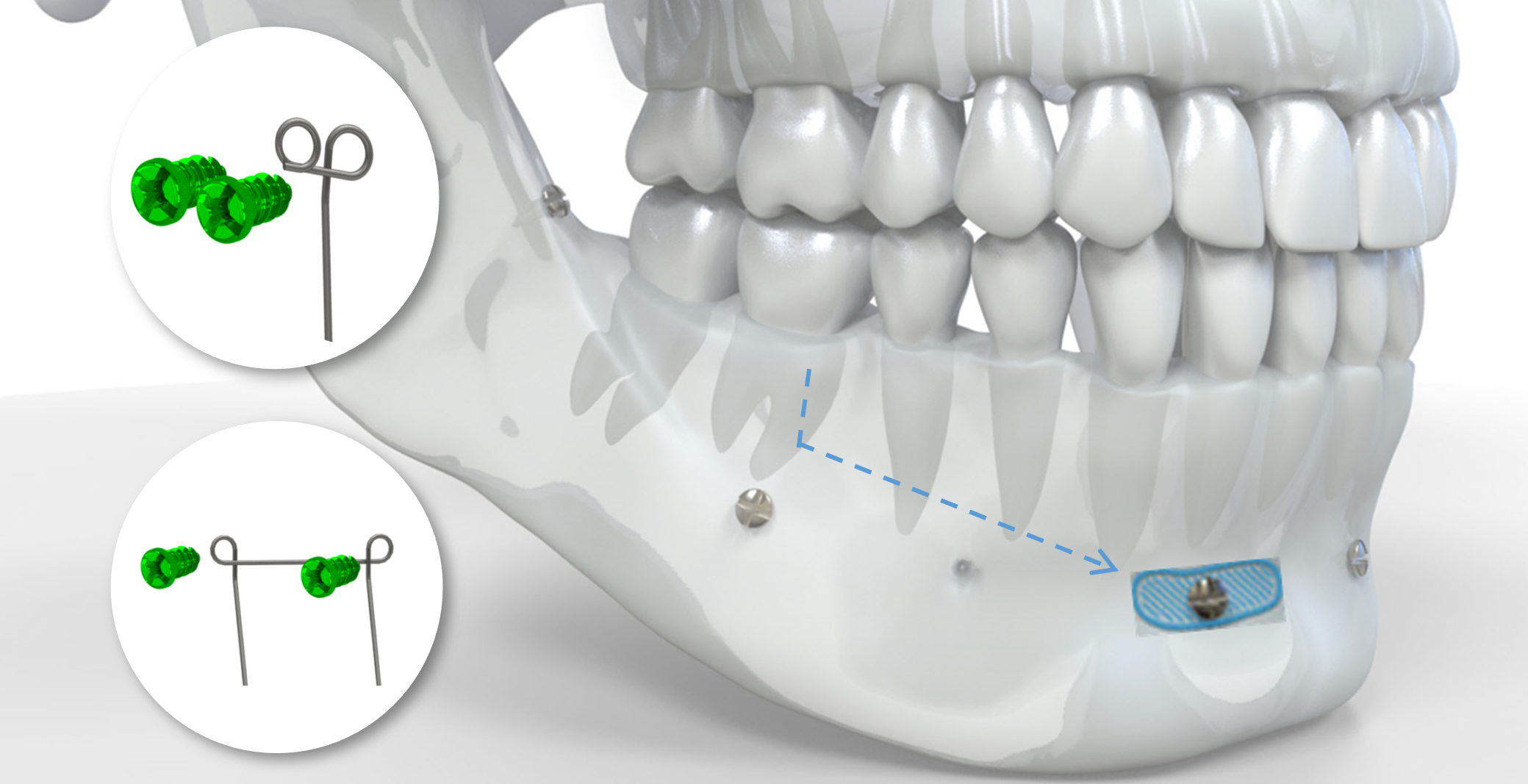 Implantation mésialisation molaire inférieure