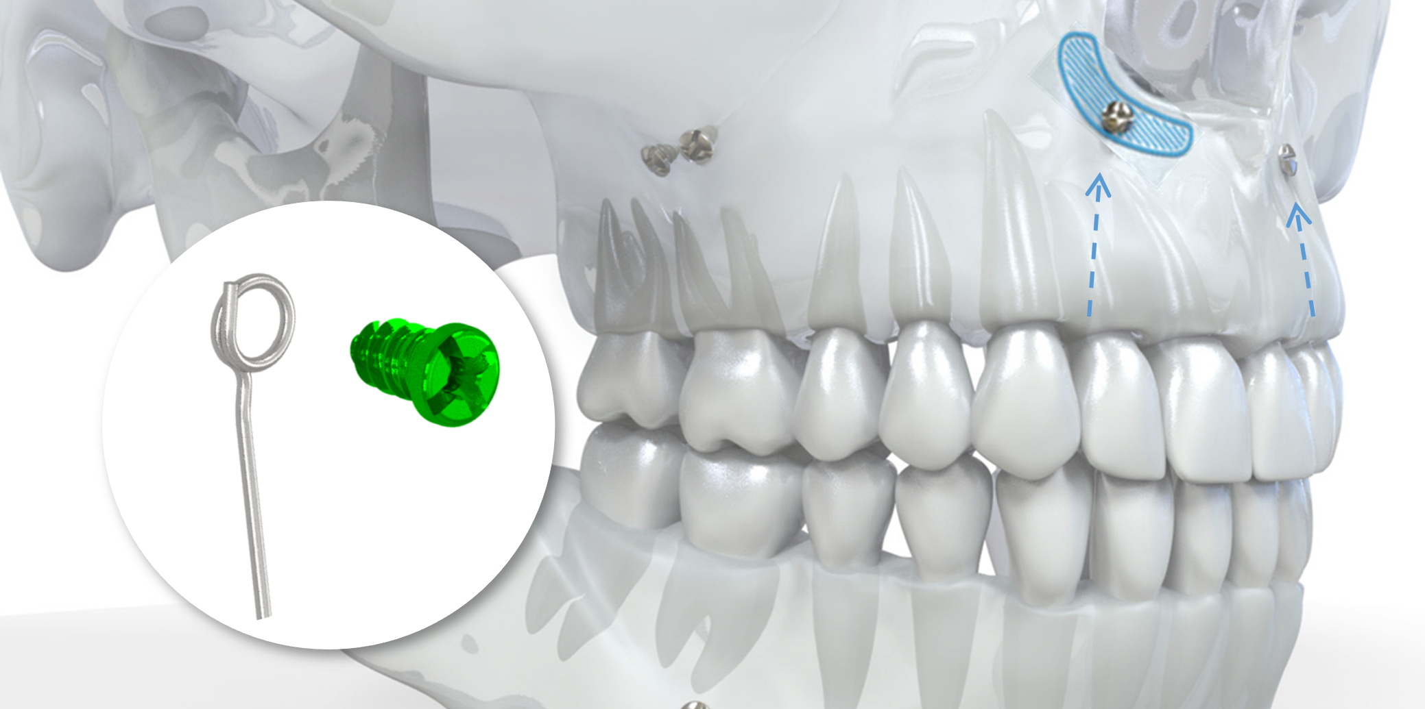 Implantation orifice piriforme