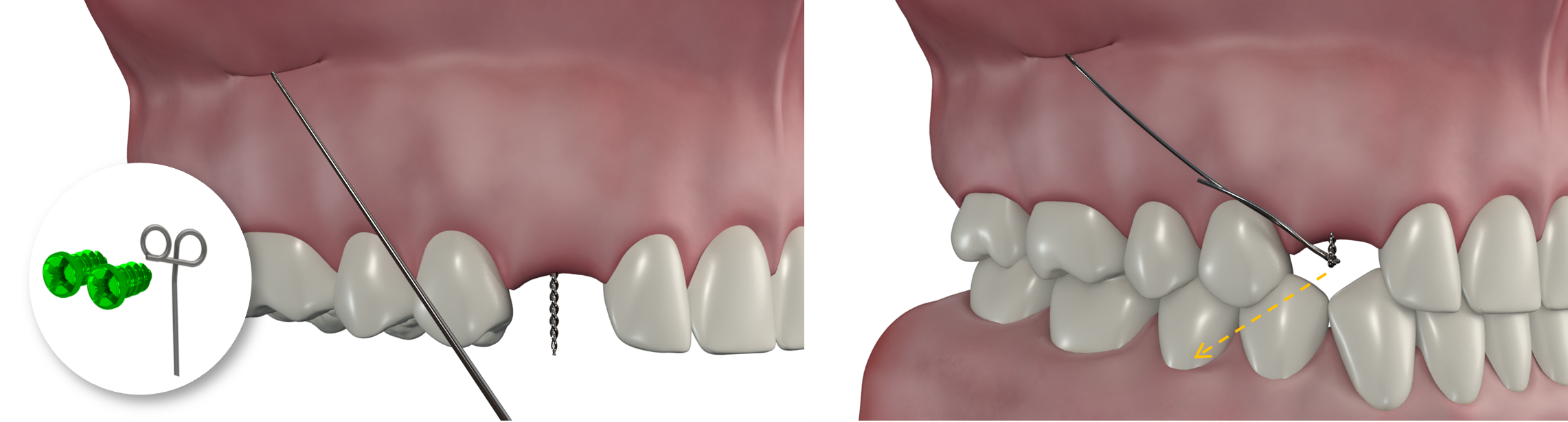 Implantation canine maxillaire