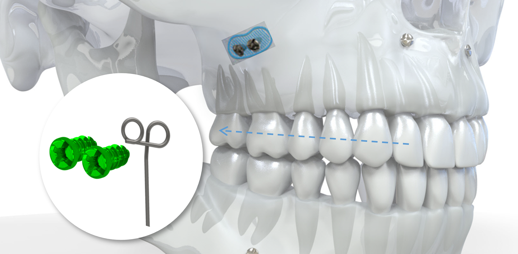 Implantation zygomatique contrôle 3D