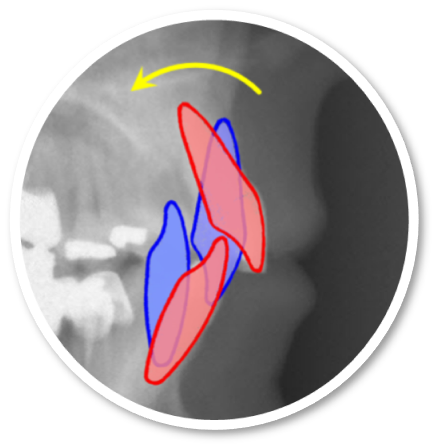 Ingression supérieure et torque