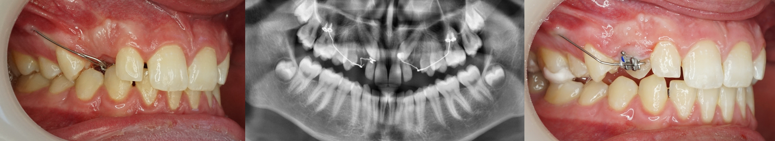 Traction canine maxillaire