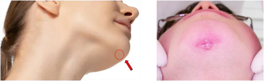 A gauche, zone sous-mentonnière à risque, susceptible de blessures consécutivement au port du masque facial chez le patient hyperdivergent. A droite, blessure consécutive à une pression excessive de l’appui mentonnier.