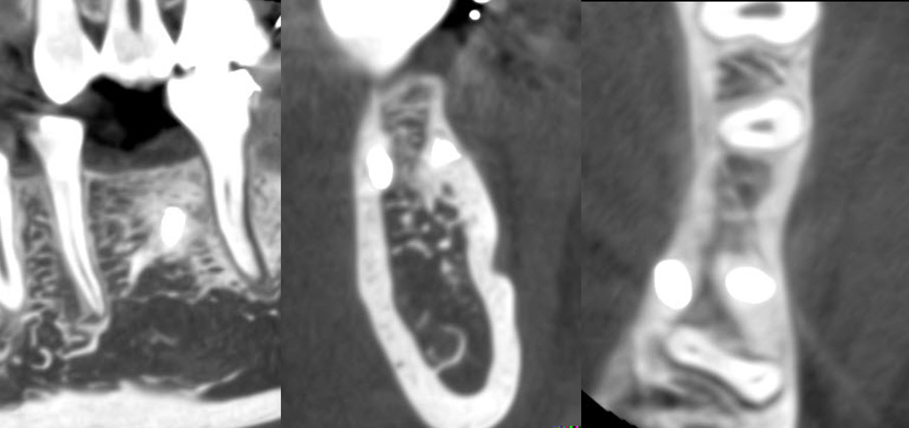 Figure 4 : cas 1, coupes CBCT à 3 ans