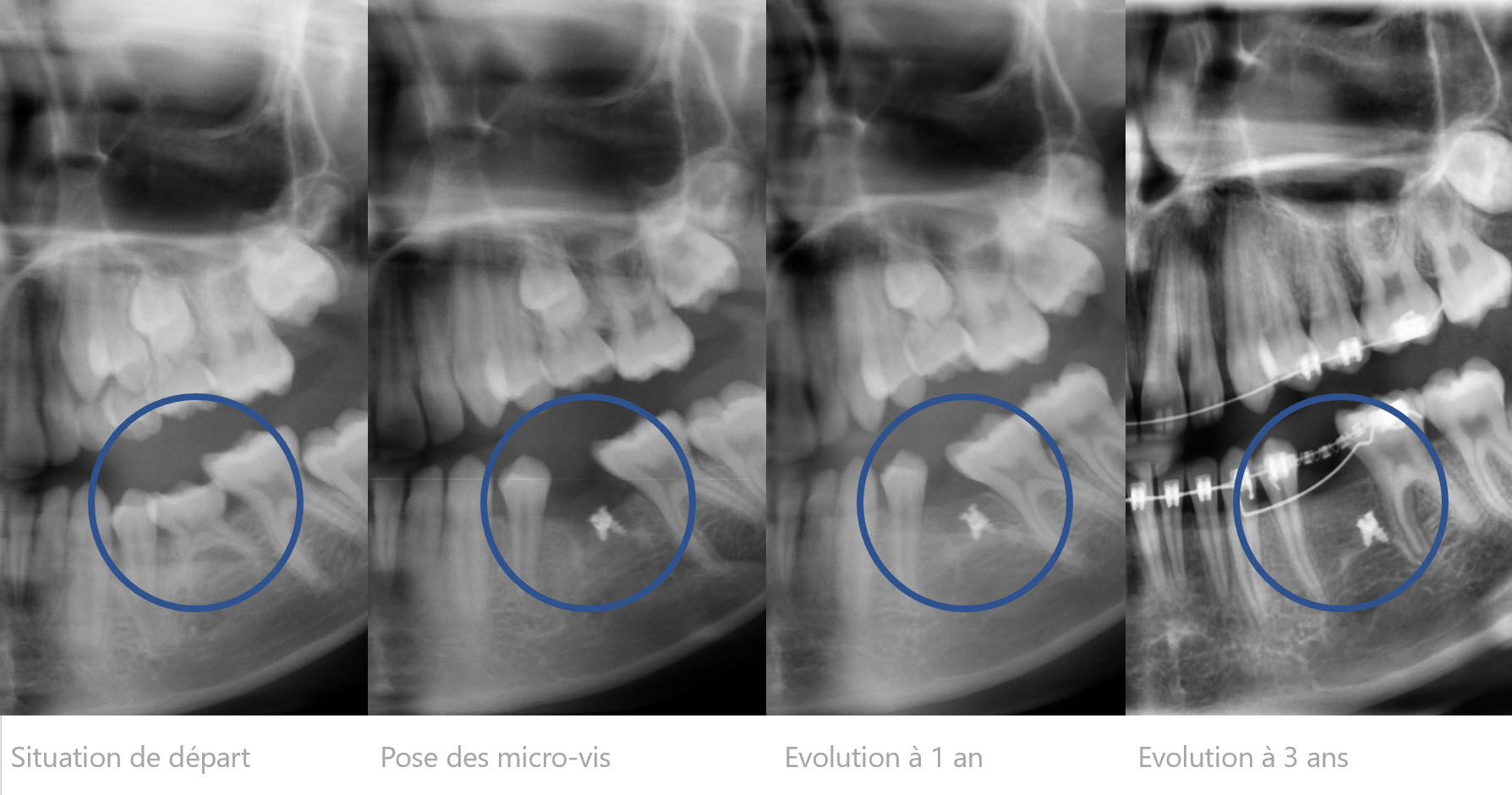 Figure 3 : cas 1, suivi radiographique de la croissance osseuse sur 3 ans