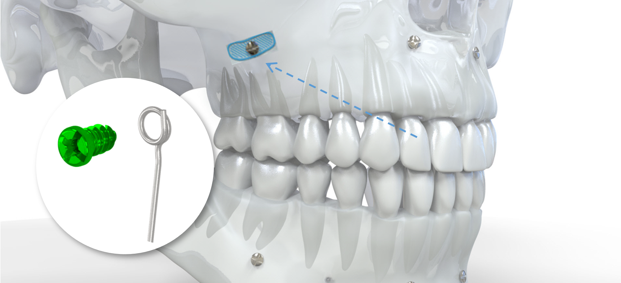 Implantation zygomatique contrôle 1D