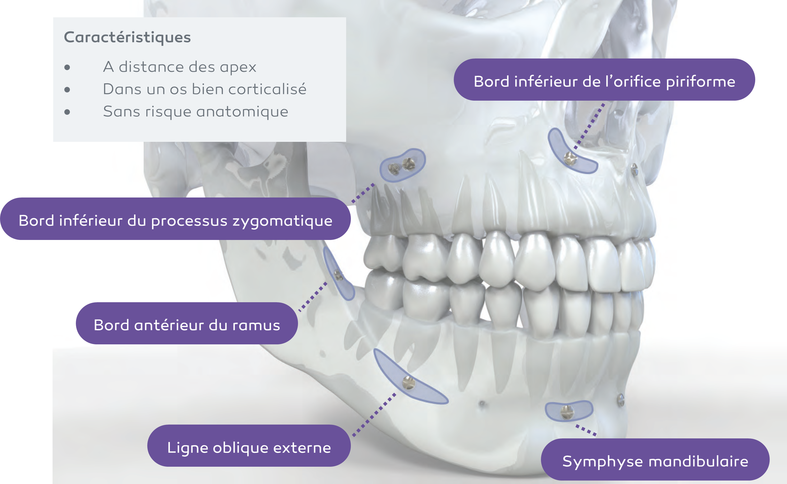 Site implantations