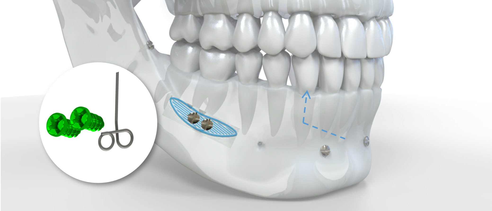 Implantation canine mandibulaire