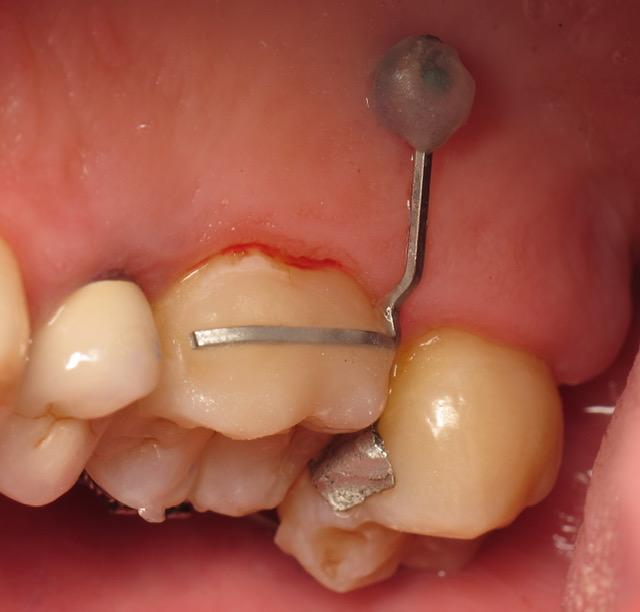 Mini-vis d'ancrage en orthodontie orthoLemay.com.mov 