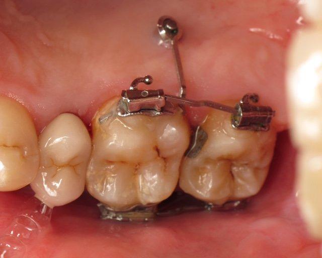 Utilisation des mini-implants d'ancrage en orthodontie pré-prothétique  sectorielle