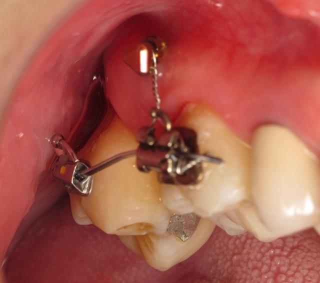 Mini-vis d'ancrage en orthodontie orthoLemay.com.mov 