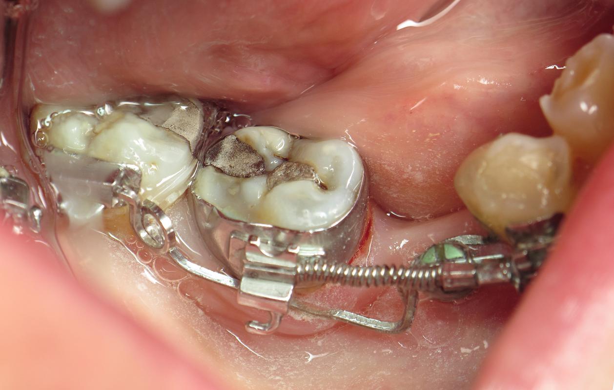 Minivis d'ancrage orthodontique DX-OMIA System