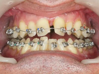 Figure 14 : évolution à 5 mois, 6 semaines post opératoires, 3 semaines après arrêt de la disjonction, pose du multi-attaches, vue de face