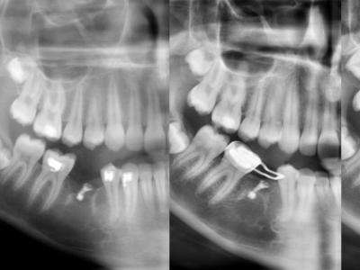 Figure 6  : cas 2, suivi radiographique de la croissance osseuse sur 3 ans