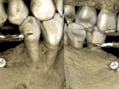 Figure 8 : cas 2, rendu surfacique au CBCT à 3 ans