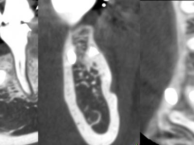 Figure 4 : cas 1, coupes CBCT à 3 ans