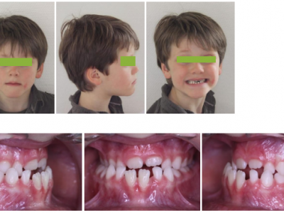 Fig.10 Photographies faciales et intraorales avant traitement