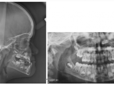 Fig. 11 Radiographies avant traitement