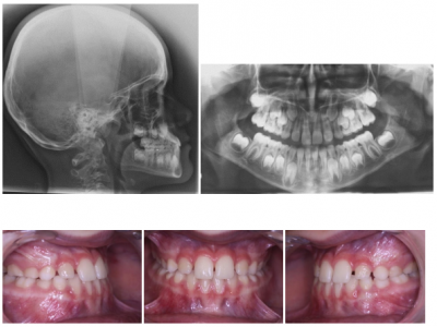 Fig. 14 Radiographies et photographies intraorales 3 mois après la fin du traitement