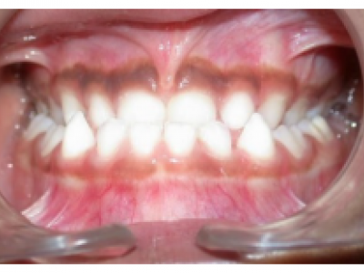 Fig. 1 Photographies intraorales initiales