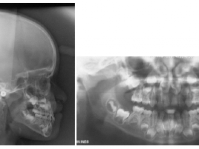 Fig. 3 Radiographies avant traitement