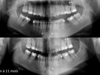 Des corticotomies entre 5 et 7, un ancrage symphysaire avec système CT8® et un appareil multi-attaches permettent de mésialer les deuxièmes et troisièmes molaires (b).