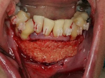 mise en place de l’allogreffe en vestibulaire des dents où une expansion est prévue (c)