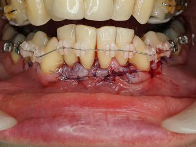sutures et mise en charge orthodontique immédiate (e)