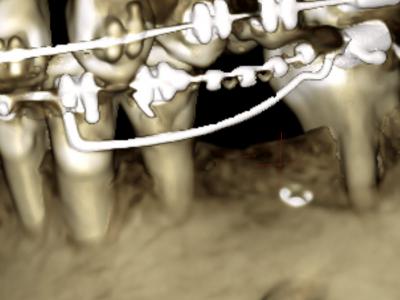 Figure 5 : cas 1, rendu surfacique au CBCT à 3 ans