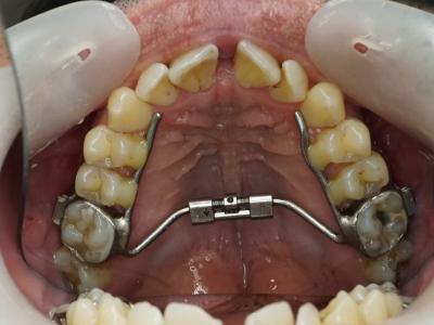 Figure 13 : évolution à 4 mois, 2 semaines post opératoires, disjonction en cours, vue de face 11 : évolution à 3 mois, pose du disjoncteur, vue occlusale