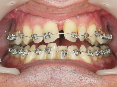 Figure 14 : évolution à 5 mois, 6 semaines post opératoires, 3 semaines après arrêt de la disjonction, pose du multi-attaches, vue de face