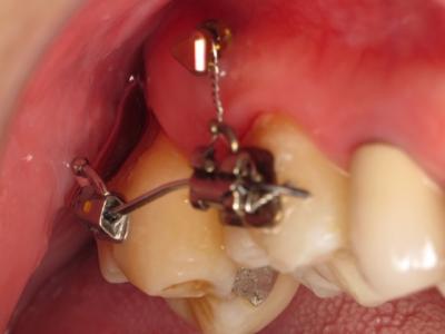 Cas 1 - Vue vestibulaire initiale