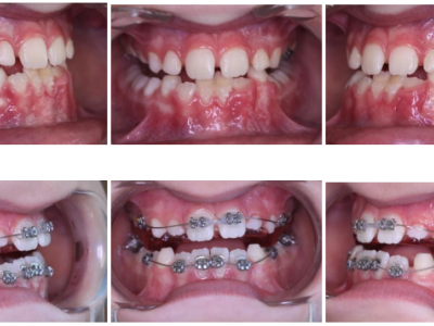 Fig. 12 Photographies intraorales quand le recouvrement incisif est obtenu