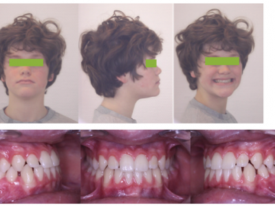 Fig. 15 Photographies faciales et intraorales 4 ans plus tard