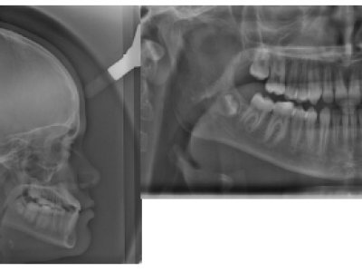 Fig. 16 Radiographies 4 ans après la fin du traitement orthopédique pour envisager une finition multi-attaches