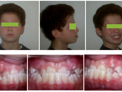 Fig. 17 Photographies faciales et intraorales avant traitement