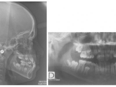 Fig. 18 Radiographies avant traitement.