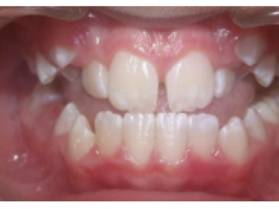 Fig. 19 Photographies intraorales après 2 mois