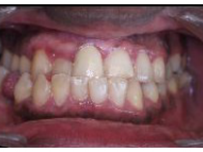 Fig. 2 Photographies intraorales de la bouche du père