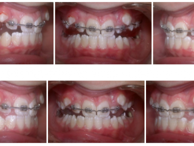 Fig. 20 Photographies intraorales quand le recouvrement incisif est obtenu avec et sans appareil