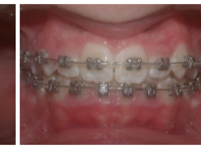 Fig. 22 Photographies intraorales en finition multi-attaches