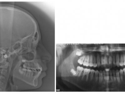 Fig. 24 Radiographies après la dépose des attaches