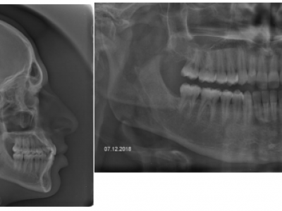 Fig. 26 Radiographies 10 ans après traitement, 9 ans après contention