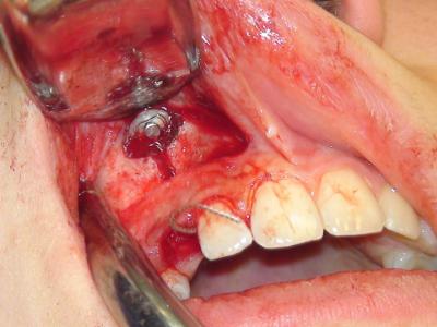Un tracé de corticotomie large permet de faciliter le redressement de cette dent et de la guider vers son alvéole (b).