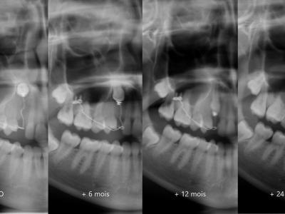 Une traction avec un système CT8® zygomatique droit permet la mise en place de la canine sans multi-attaches en 24 mois (c).